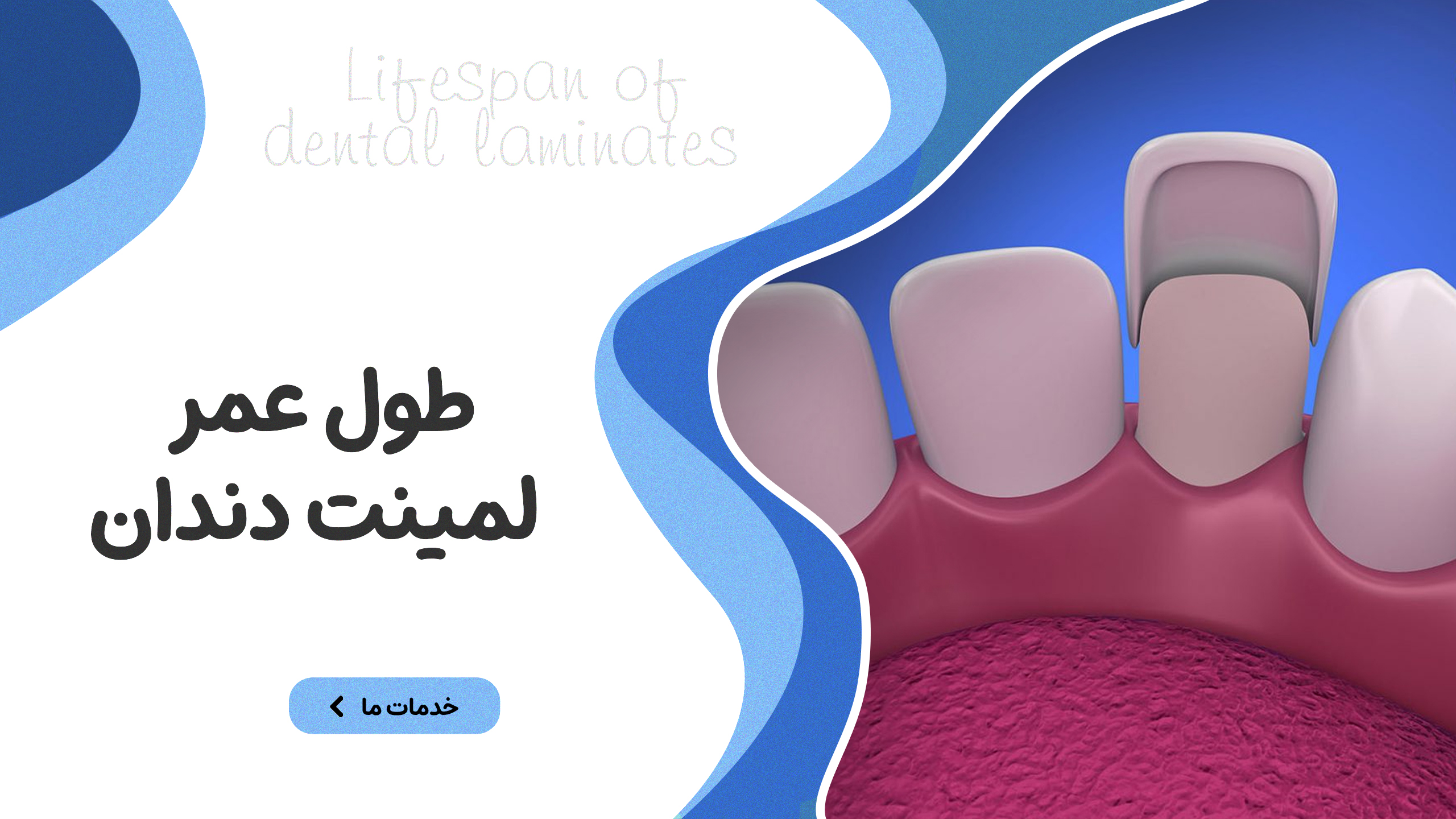 طول عمر لمینت دندان